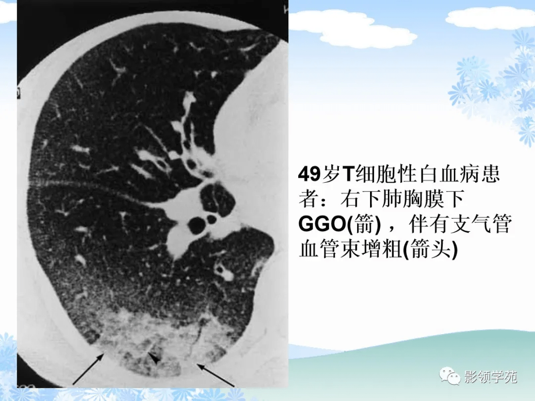 贝伐珠单抗靶向是啥_肺癌晚期注射贝伐单抗_贝伐单抗是靶向药吗