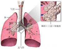 肺癌晚期服吉非替尼生存期_肺癌晚期化疗_肺癌晚期能治吗