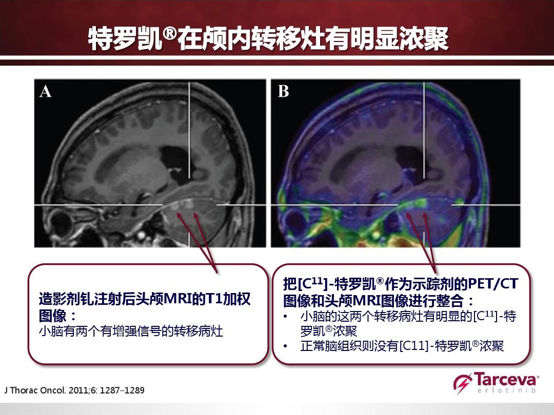 肺癌患者可以吃桃胶吗_肺癌患者脑转移吃奥希替尼_肺癌转移脑怎么治疗