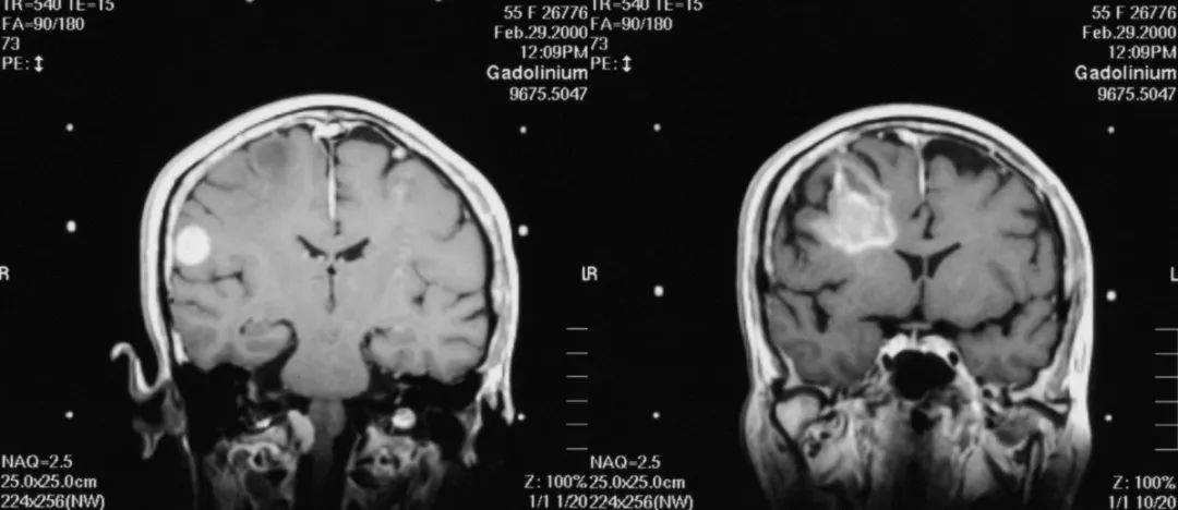 肺癌患者脑转移吃奥希替尼_肺癌转移脑怎么治疗_肺癌患者可以吃桃胶吗