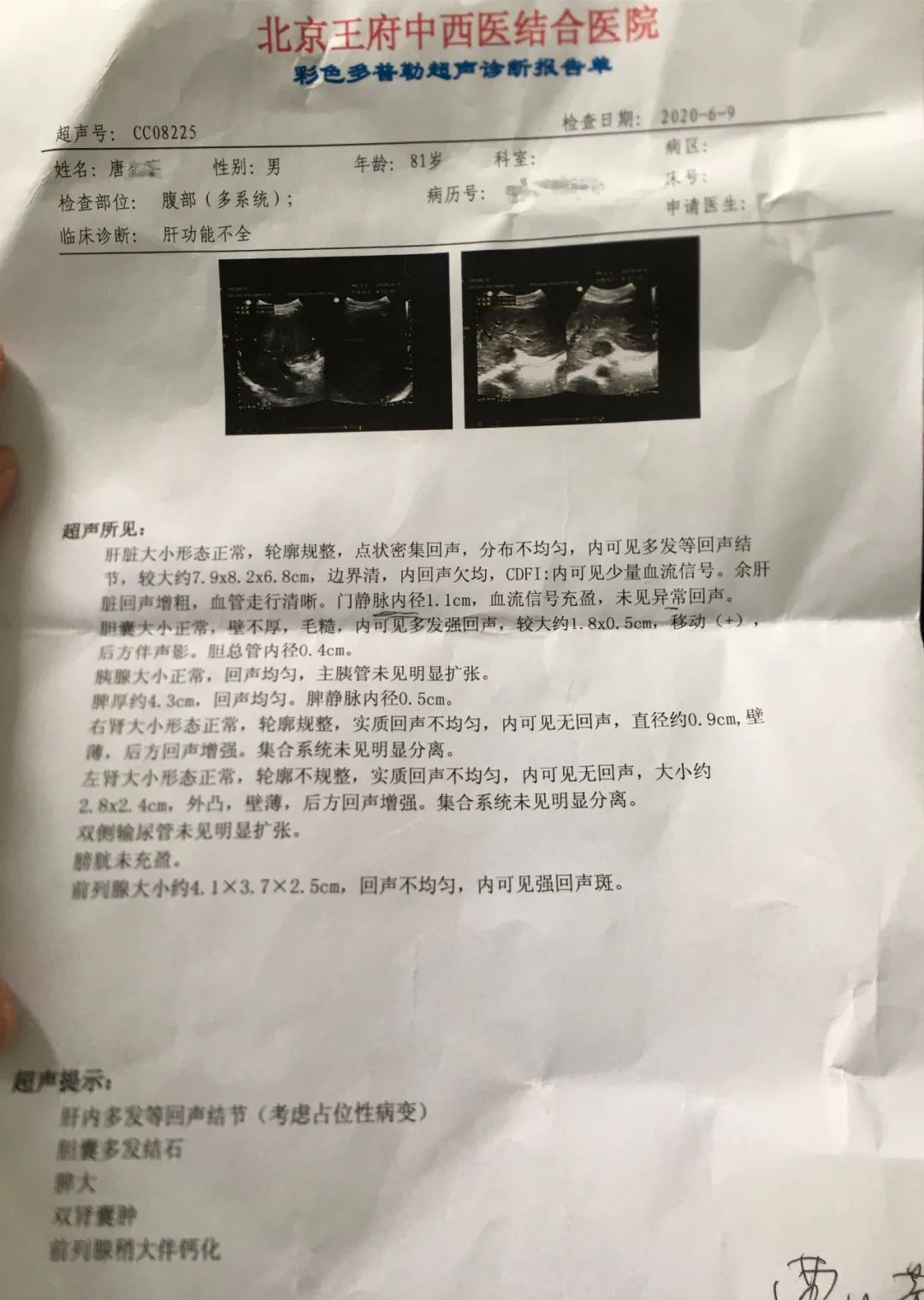 索拉非尼治肝癌用什么药_索拉非尼肝癌延长时间_pdone治癌症药肝癌