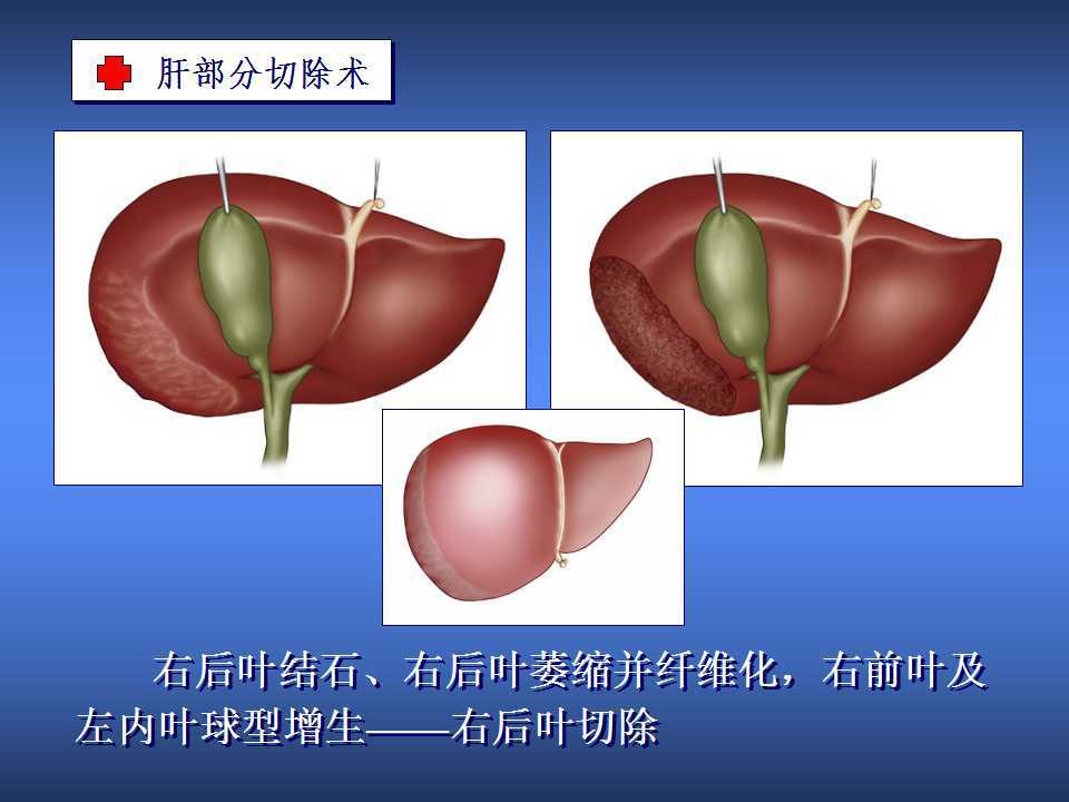 西妥昔单抗贝伐单抗_贝伐珠单抗是化疗吗_贝伐单抗的生存期