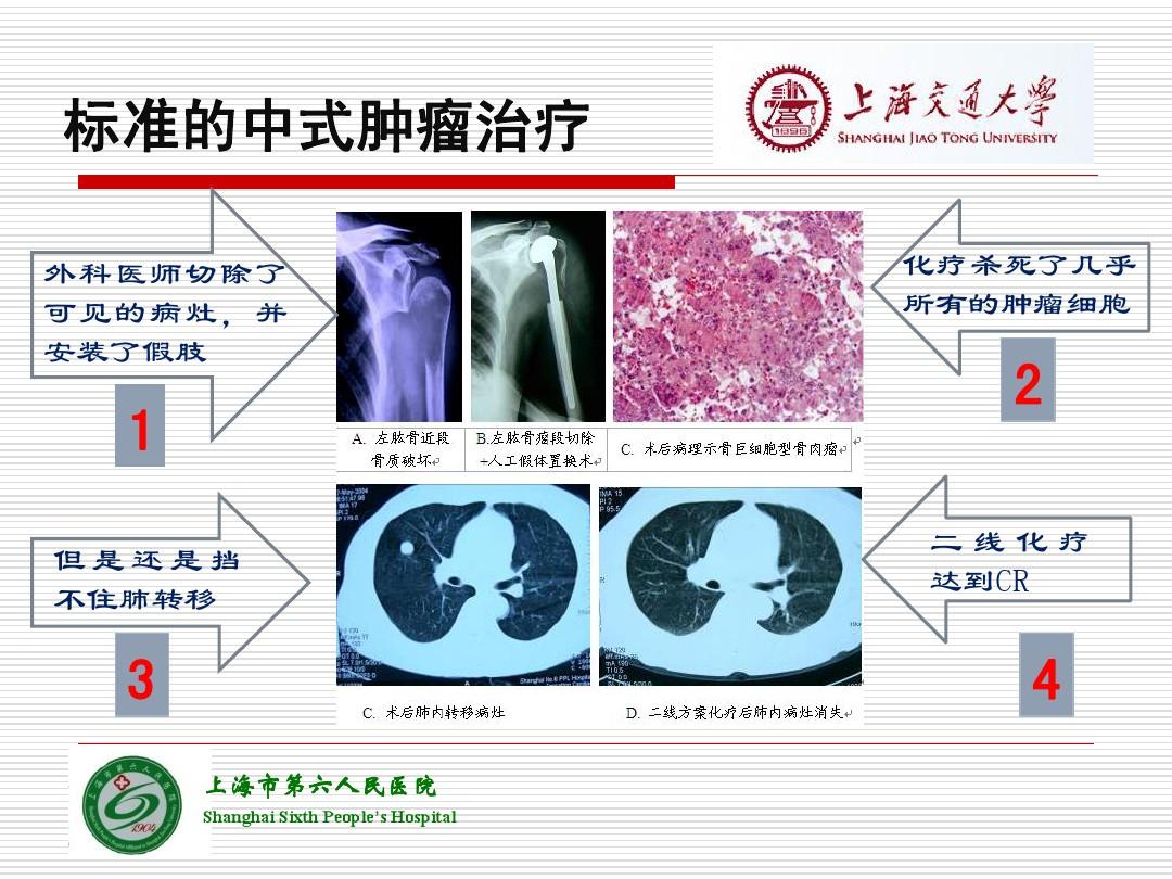 azd9291奥希替尼_奥希替尼脑膜转移原理_进口奥希替尼