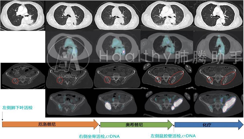 中国版奥希替尼_奥希替尼辅助治疗研究报告_9291奥希替尼价格