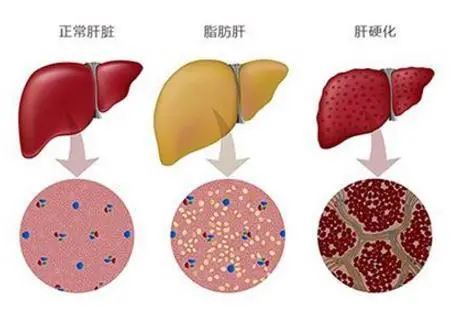 吃索拉非尼效果怎么样_肝爽颗粒能长期吃吗_酒精性肝硬化能吃索拉非尼