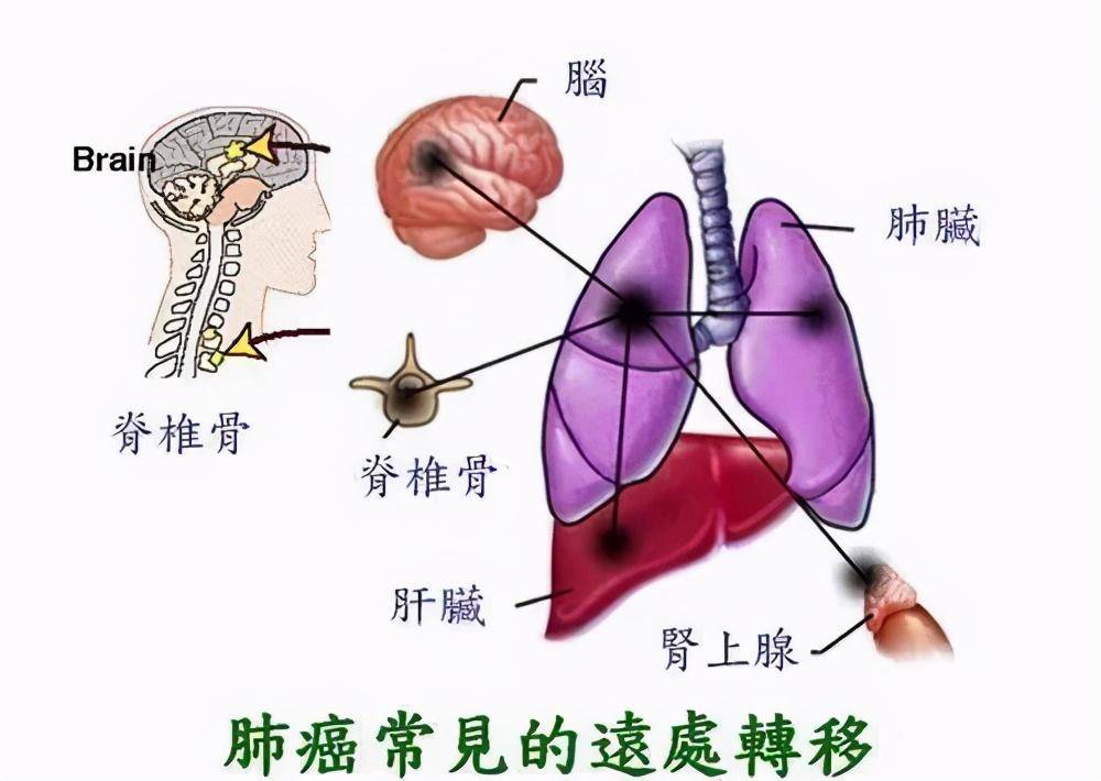 吴一龙 十年靶向没耐药_吴一龙 阿法替尼_吴一龙与奥希替尼耐药后治疗