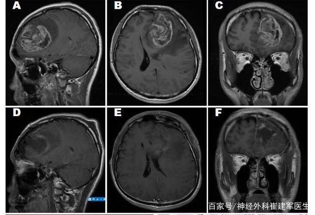 贝伐珠单抗是化疗吗_贝伐珠单抗治疗肺腺癌_贝伐珠单抗肝细胞癌适应症