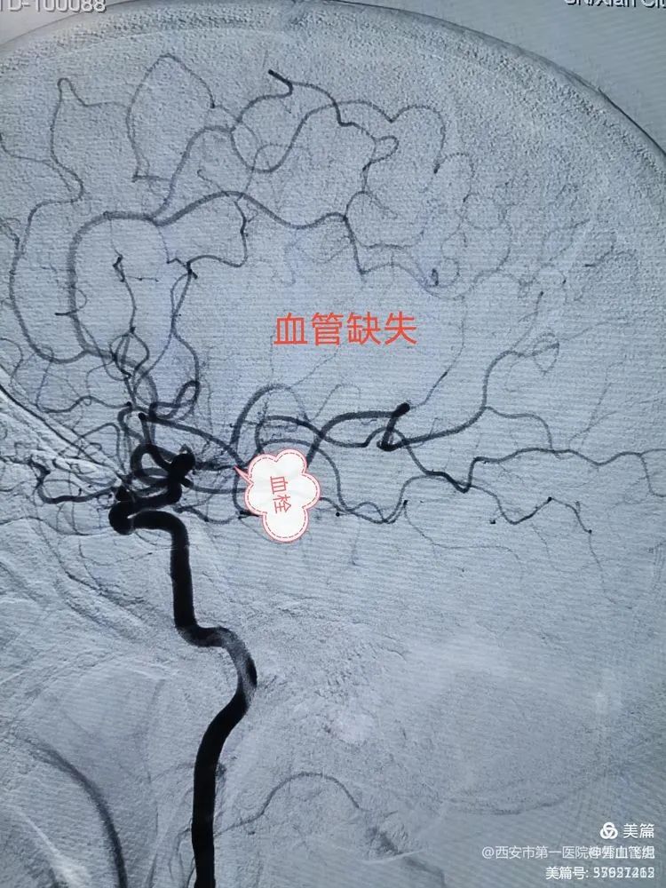 贝伐珠单抗多少钱一支_贝伐珠单抗靶向是啥_脑水肿可以用贝伐珠单抗吗