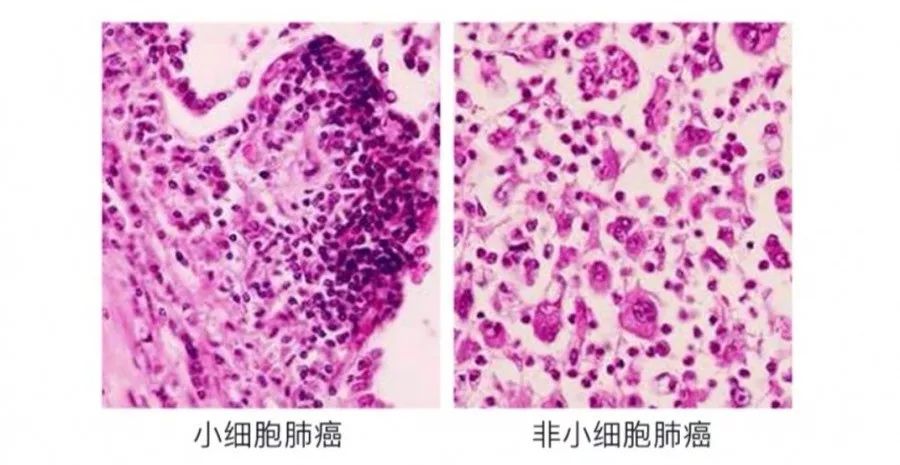 奥希替尼9291治愈肺癌_肺癌靶向新药9291耐药_肺癌治愈偏方