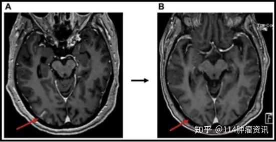 奥希替尼9291_无基因突变吃奥希替尼怎么样_阿斯利康 奥希替尼