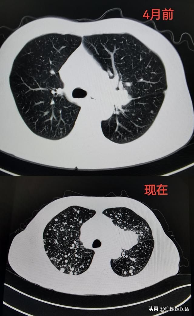 贝伐珠单抗4个月后赠药_贝伐珠单抗可以报销吗_贝伐珠单抗一支多少毫升