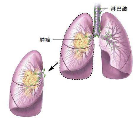 奥希替尼印度版白盒_奥希替尼9291药品_奥希替尼是啥药