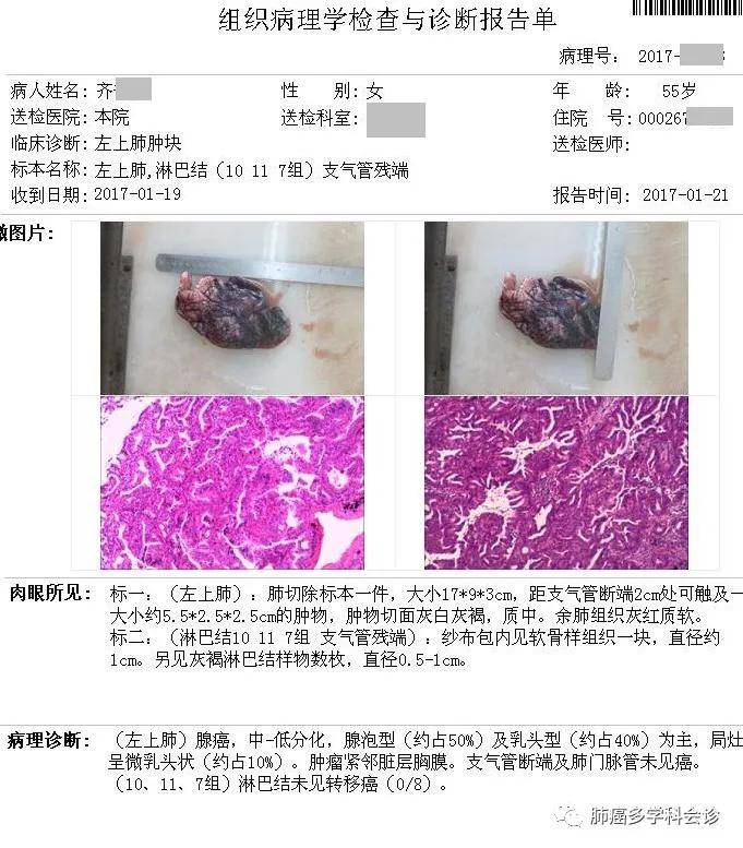 肺腺癌吉非替尼耐药要不要化疗_结肠癌腺癌分期和化疗_睑板腺癌化疗