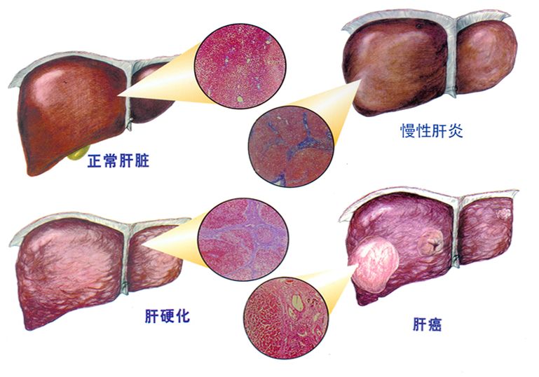 靶向药对什么癌效果好_肺癌肝转移 靶向药_肝静脉癌栓靶向药索拉非尼