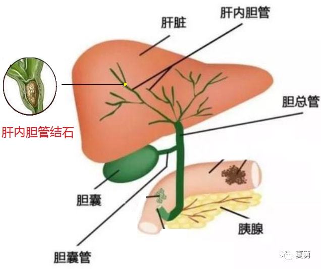 索拉非尼的赠药政策_癌栓吃靶向药有用吗_肝静脉癌栓靶向药索拉非尼