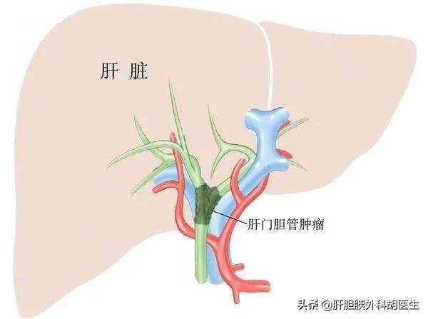 肝静脉癌栓靶向药索拉非尼_癌栓吃靶向药有用吗_索拉非尼的赠药政策