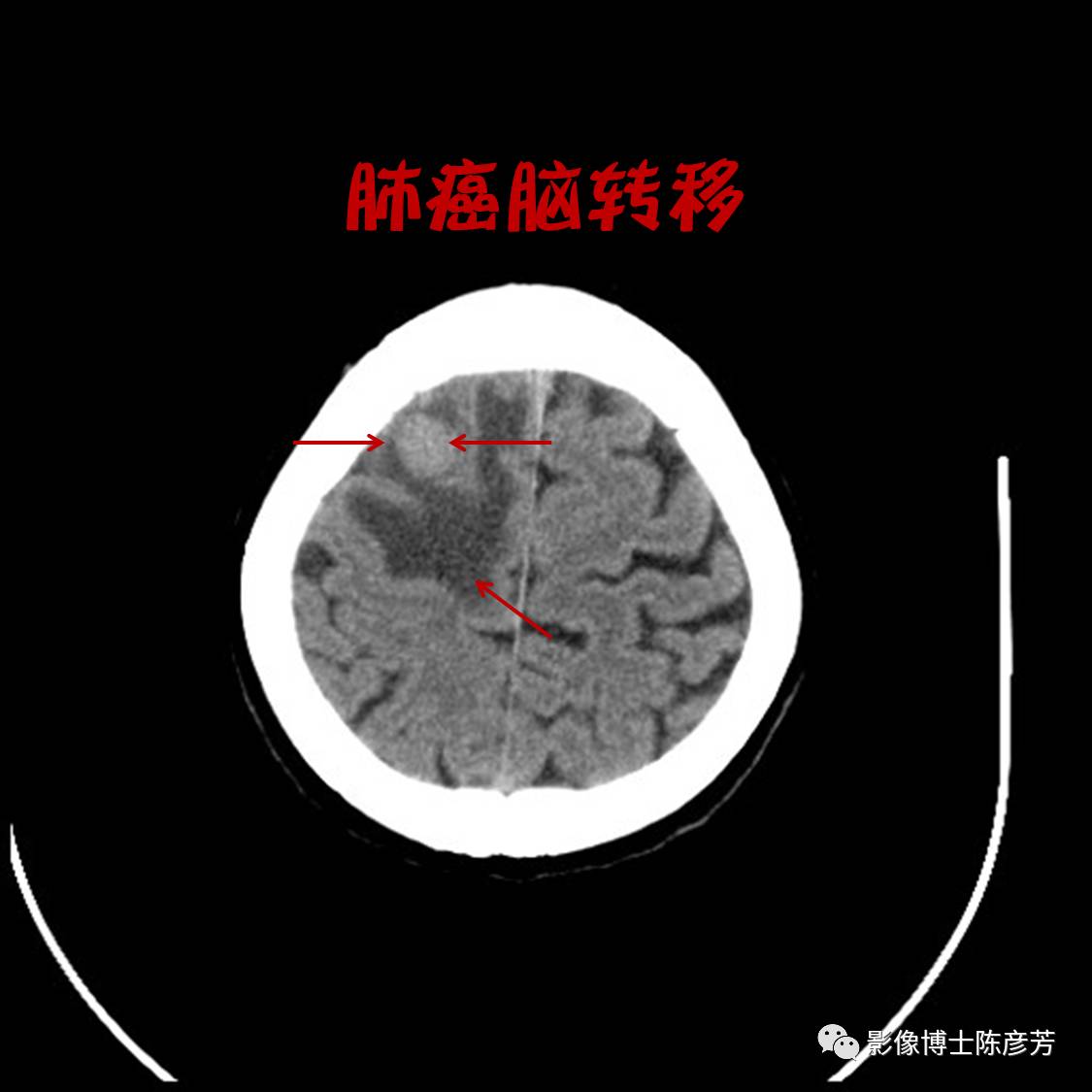 奥希替尼9291药品_奥希替尼都有哪里产的_奥希替尼对肺癌脑转移有何作用