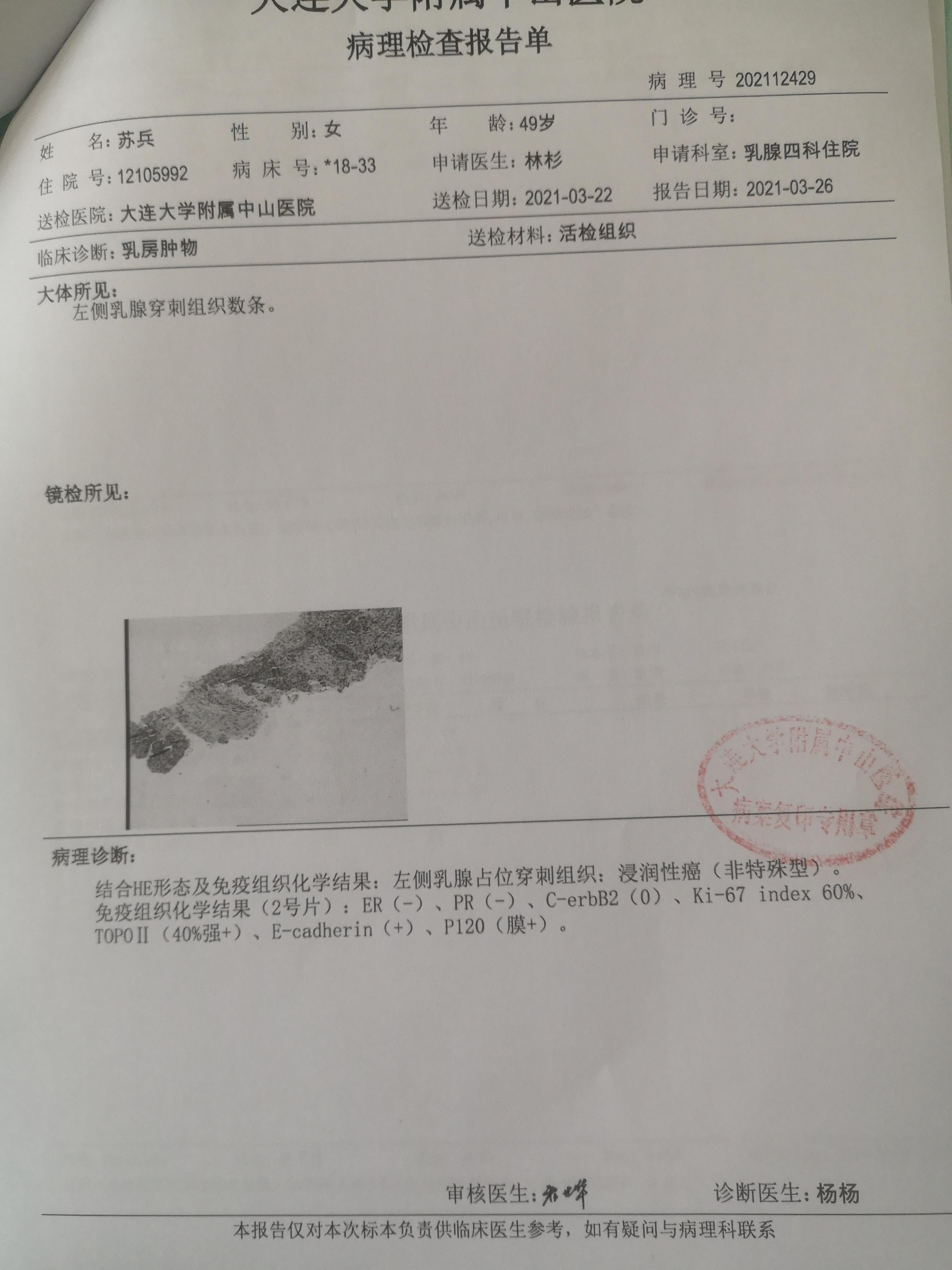 贝伐珠单抗 耐药性_贝伐珠单抗不良反应_贝伐珠单抗三阴乳腺癌用法用量