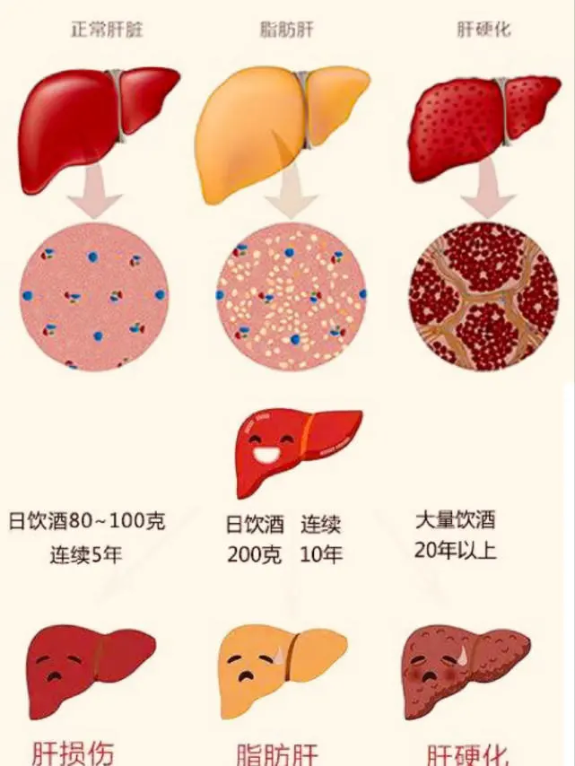 服用吉非替尼后谷丙转氨酶升高_丙谷转氨酶高和丙草_丙谷转氨酶高吃什么药