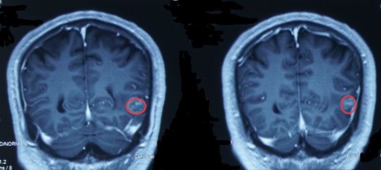 奥希替尼多少钱一盒_肺腺癌脑转移患者用奥希替尼_奥希替尼印度版白盒