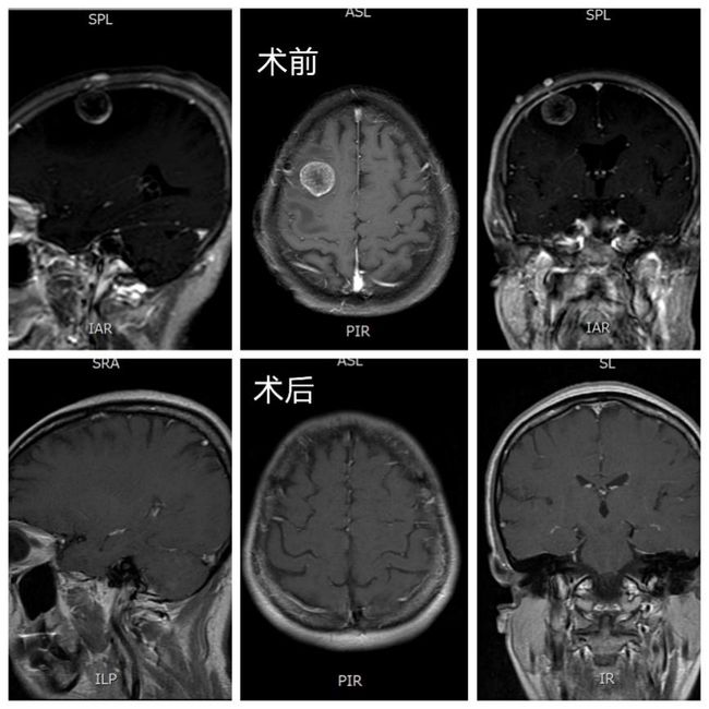 奥希替尼多少钱一盒_肺腺癌脑转移患者用奥希替尼_奥希替尼印度版白盒