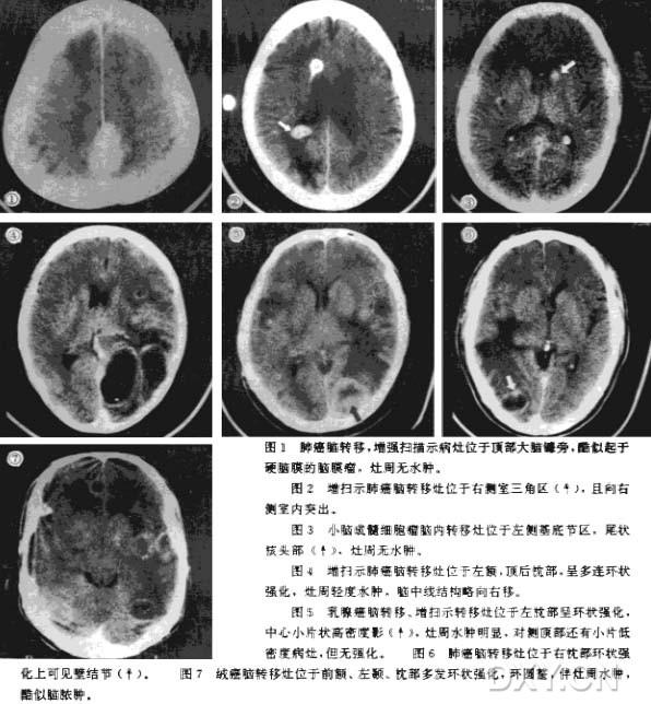 贝伐珠单抗多少钱一支_贝伐单抗治疗方法_贝伐珠单抗是化疗药吗