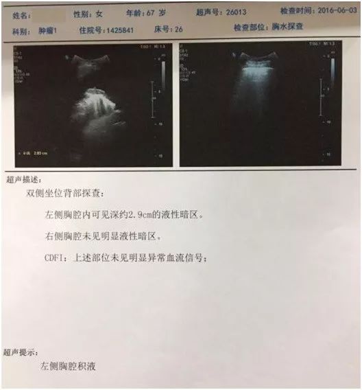 贝伐珠单抗胸腔积液肠癌_贝伐珠单抗最新价格_贝伐珠单抗