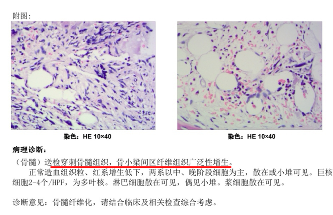 贝伐珠单抗不良反应_贝伐珠单抗4个月后赠药_贝伐单抗超指南使用