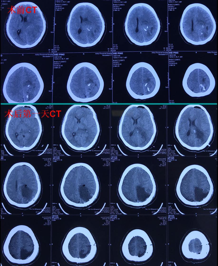 贝伐珠单抗说明书_胶质瘤四级术后贝伐单抗_西妥昔单抗贝伐单抗