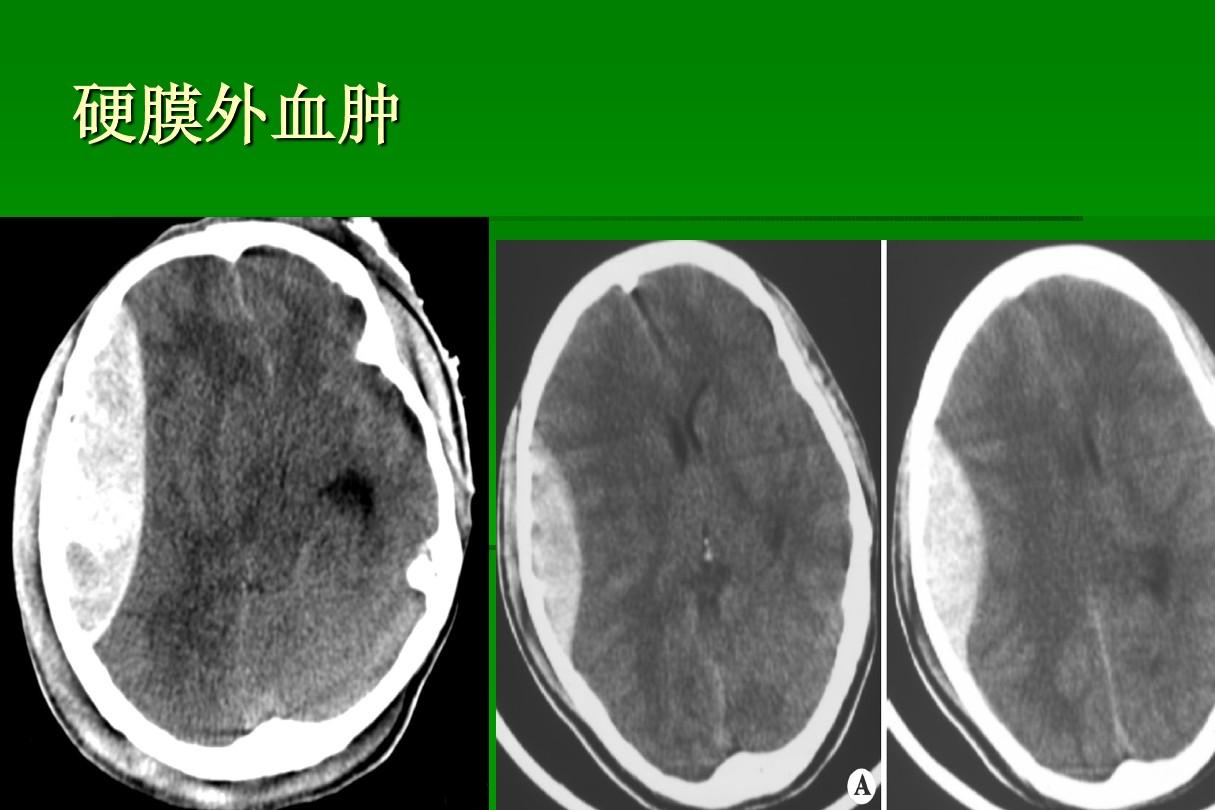 贝伐单抗肺腺癌出血_贝伐珠单抗是化疗药吗_肺癌新药贝伐单抗