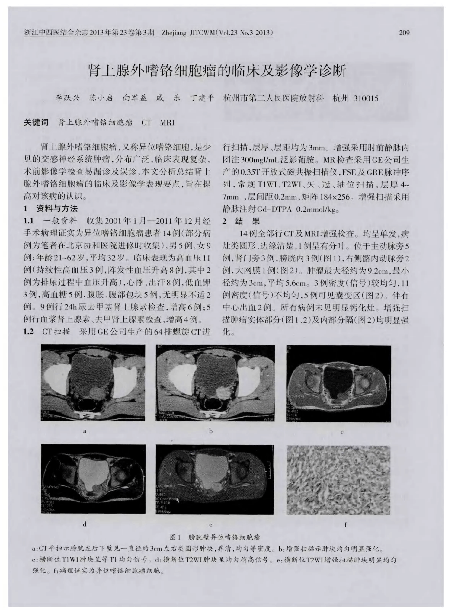 贝伐珠单抗可以报销吗_贝伐单抗多久有耐药性_贝伐单抗治理胶质瘤