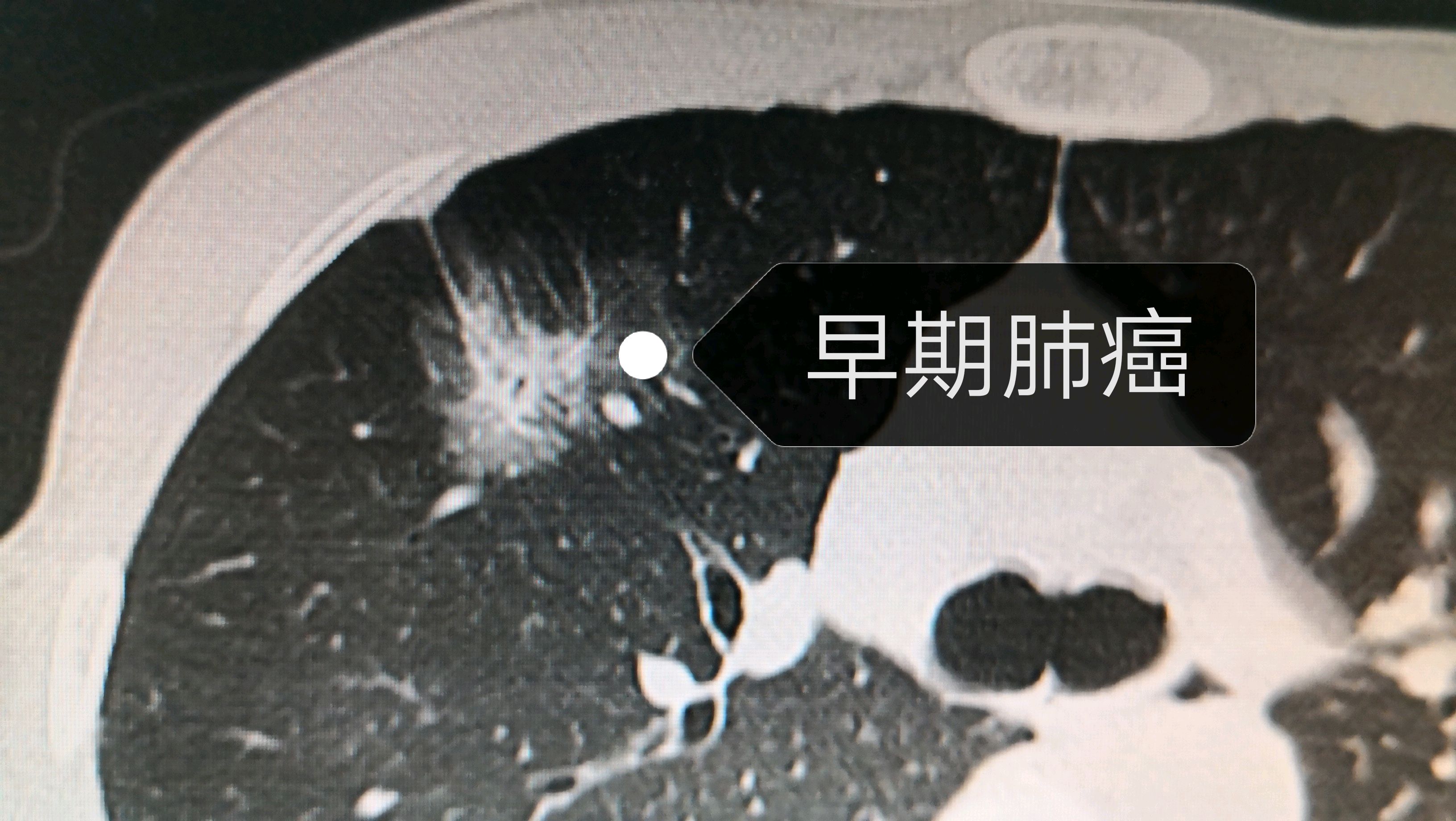 厄洛替尼片和盐酸厄洛替尼_厄洛替尼和吉非替尼是一种药_苹果酸舒尼替尼有替代药吗