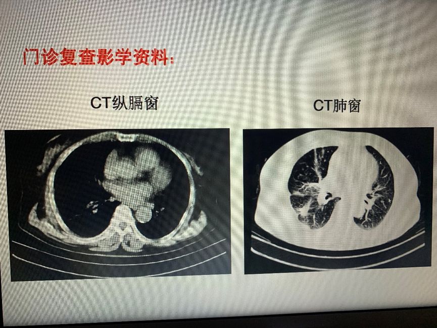 肺癌晚期治愈案例_肺癌晚期扩散能治愈吗_肺癌晚期吃吉非替尼能治愈么