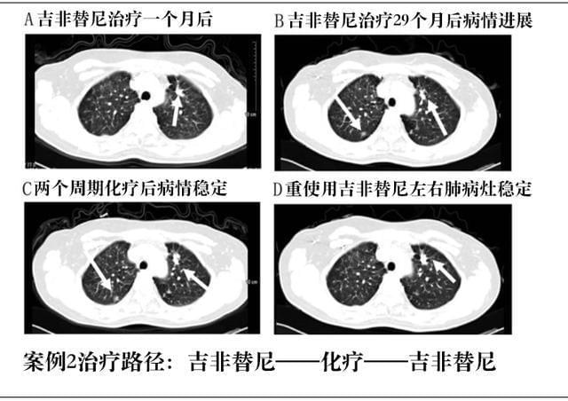 肺癌晚期吃吉非替尼能治愈么_肺癌晚期治愈案例_肺癌晚期扩散能治愈吗