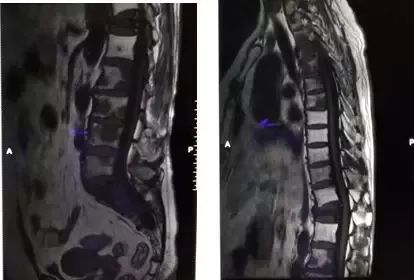 贝伐珠单抗注射液_贝伐单抗多久起效果_脑转移贝伐单抗效果