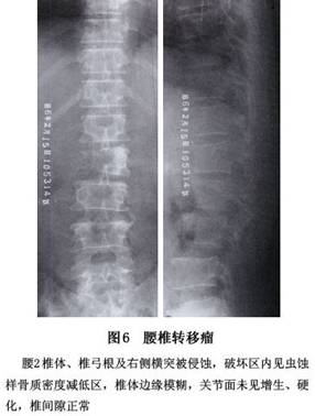 贝伐珠单抗注射液_贝伐单抗多久起效果_脑转移贝伐单抗效果