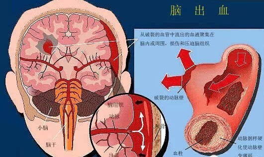 贝伐珠单抗_贝伐珠单抗是化疗药吗_脑转移贝伐珠单抗治疗周期