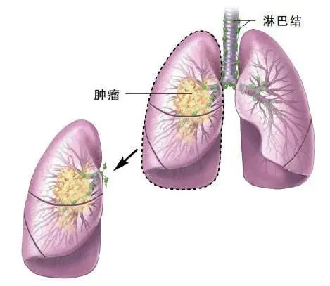 肺鳞癌晚期可以吃吉非替尼吗_肺鳞癌局部晚期化疗_晚期肺鳞癌骨转移化疗中能活多久