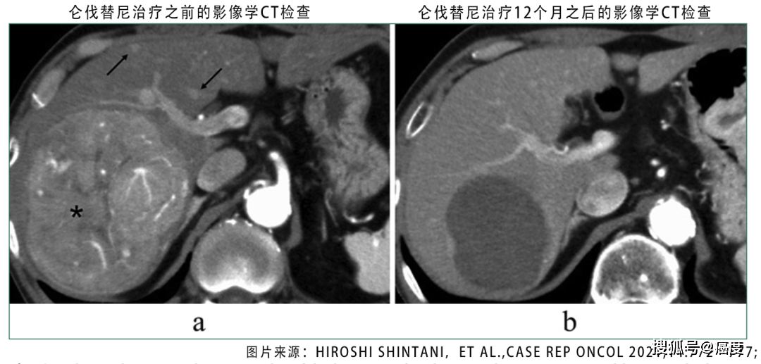 肝癌病人可以开贝伐单抗吗_贝伐珠单抗_贝伐珠单抗4个月后赠药