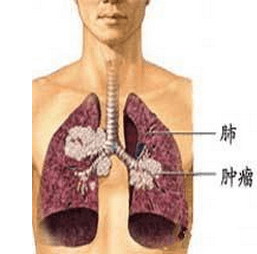 肺鳞癌有突变可以吃奥希替尼吗_肺鳞癌吃靶向药活7 8年_阿法替尼肺鳞癌