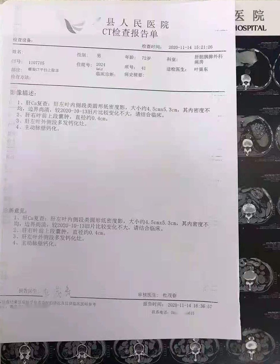 贝伐珠单抗_帕搏利珠单抗与贝伐单抗_贝伐珠单抗价格