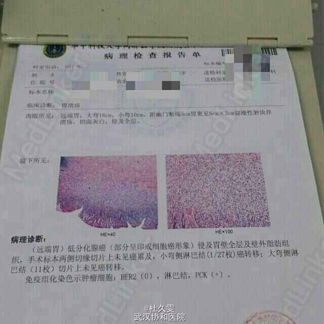 贝伐单抗与化疗联合治疗肺癌_贝伐珠单抗注射液_贝伐单抗耐药性