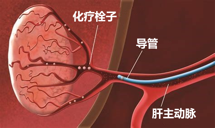 肝癌介入治疗后吃索拉非尼_索拉非尼 肝癌_索拉非尼 裸鼠肝癌