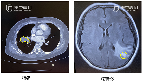 胆管细胞癌早期核磁表现_喷门癌和胃癌晚期放疗后吐血_非小细胞癌吃吉非替尼吐血