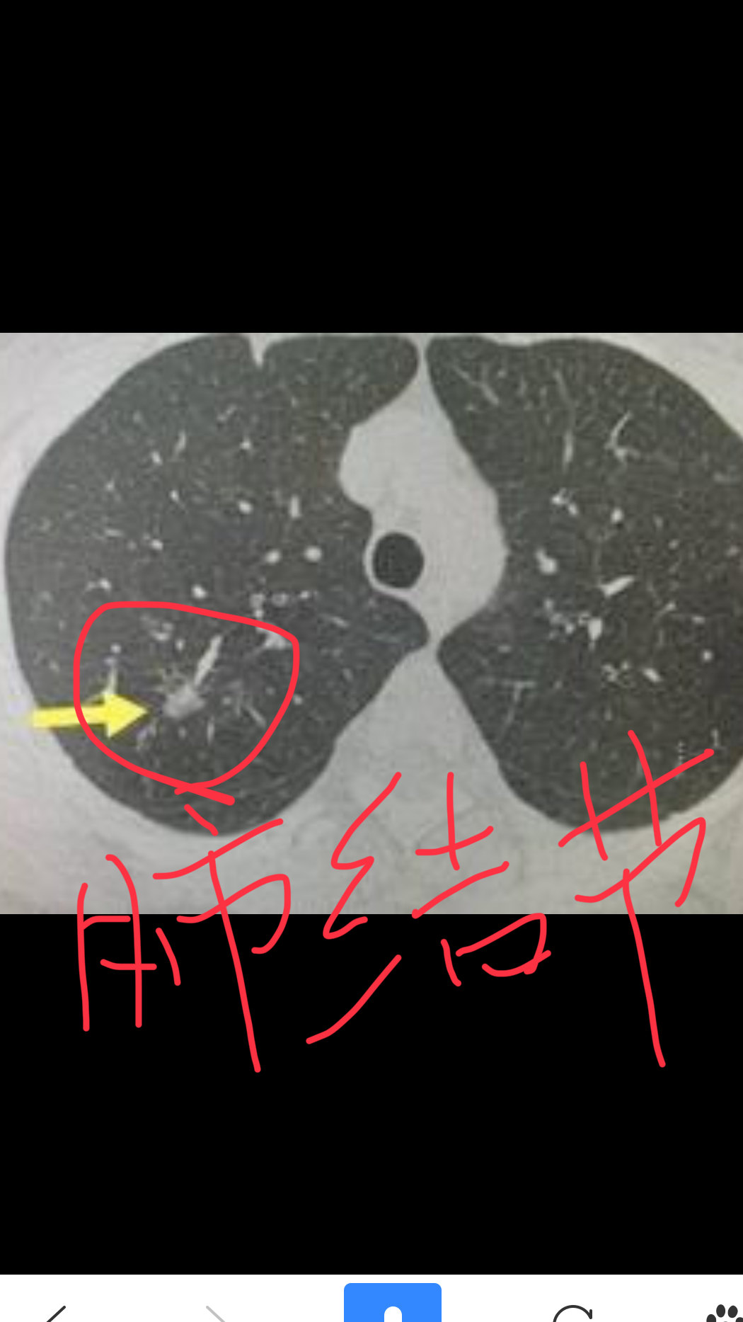 奥希替尼9291哪里买_肺腺癌吃完奥希替尼怎么办_azd 9291 奥希替尼