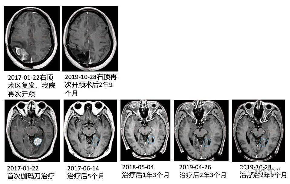 吉非替尼肺癌患者吃头痛吗_肺癌患者可以吃羊奶吗_肺癌患者可以吃糙米吗