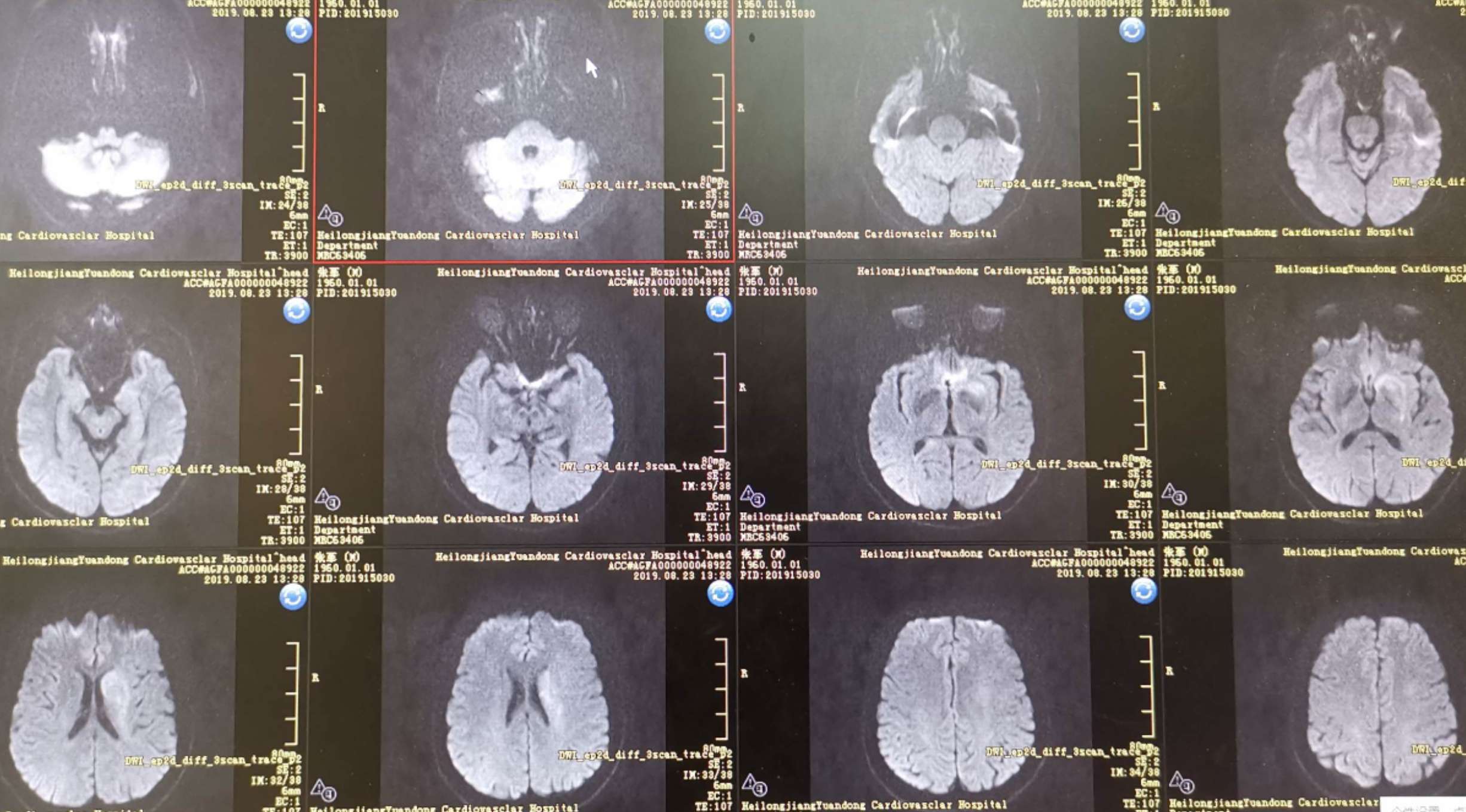 吉非替尼肺癌患者吃头痛吗_肺癌患者可以吃糙米吗_肺癌患者可以吃羊奶吗