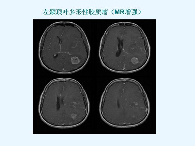 贝伐珠单抗最新价格_三级胶质瘤吃贝伐珠单抗_贝伐珠单抗注射液