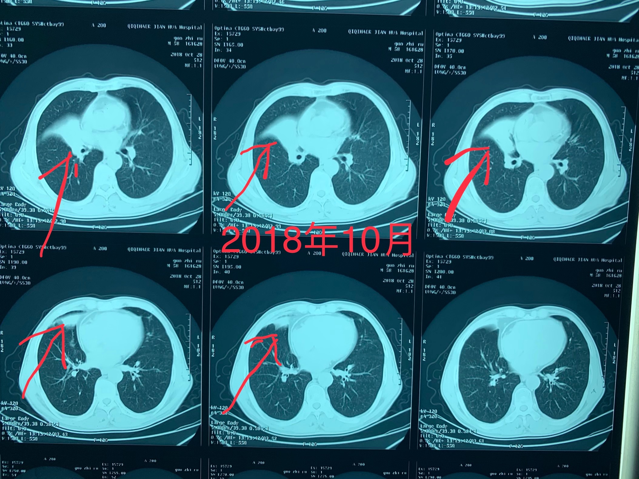 奥希替尼9291药品_奥希替尼二代靶向药_靶向药安罗替尼