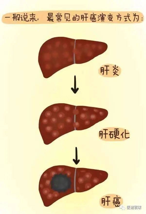 转氨酶降后重新升高_转氨酶降低胆红素升高_口服吉非替尼片转氨酶升高